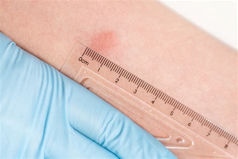 TB test results and how to interpret .